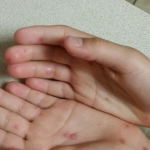hand, foot, and mouth disease